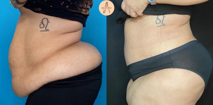 Before & After Tummy Tuck Case 37 Left Side View in San Antonio, Texas