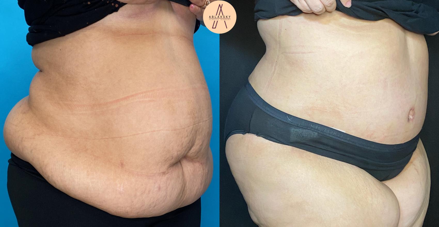 Before & After Tummy Tuck Case 37 Right Oblique View in San Antonio, Texas