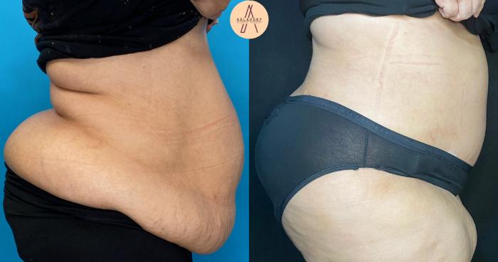 Before & After Tummy Tuck Case 37 Right Side View in San Antonio, Texas