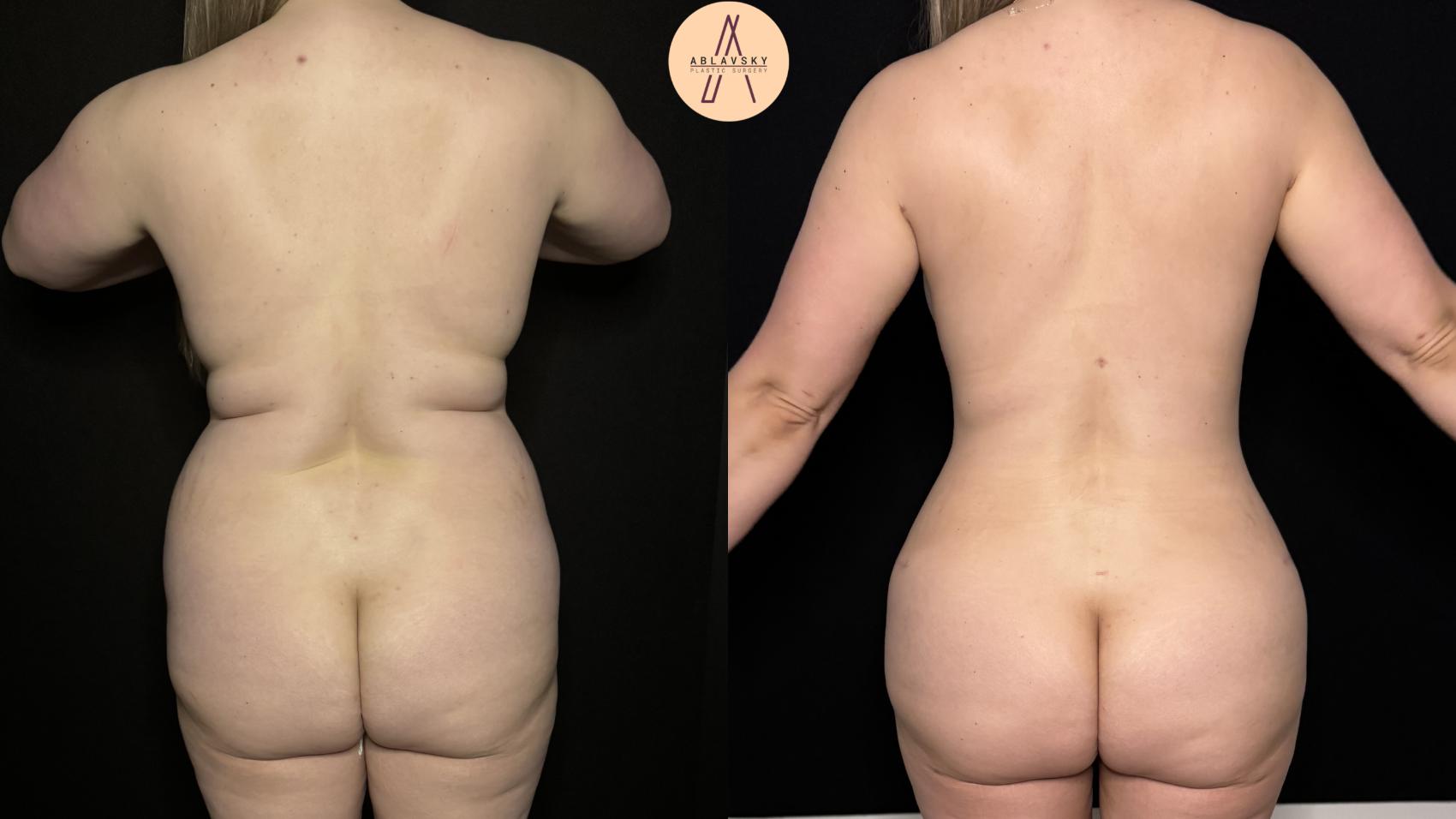 Before & After Tummy Tuck Case 397 Back View in San Antonio, Texas