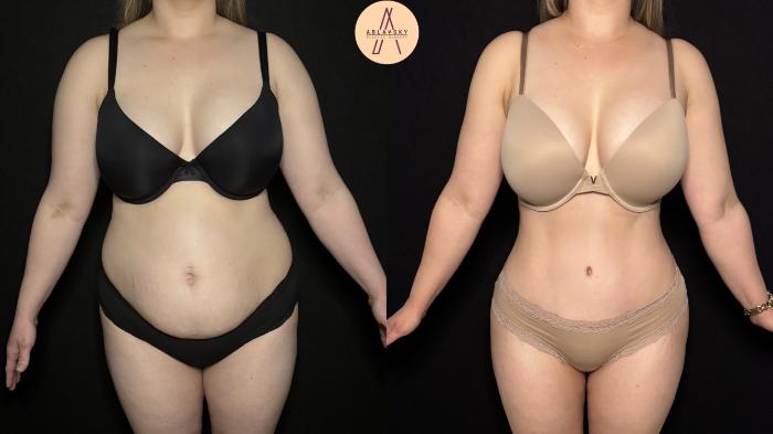 Before & After Tummy Tuck Case 397 Front View in San Antonio, Texas
