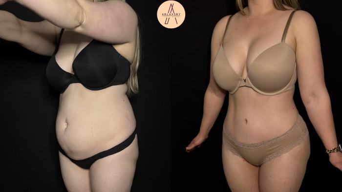 Before & After Tummy Tuck Case 397 Left Oblique View in San Antonio, Texas
