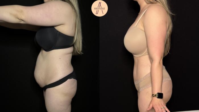 Before & After Tummy Tuck Case 397 Left Side View in San Antonio, Texas