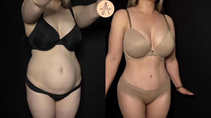 Before & After Tummy Tuck Case 397 Right Oblique View in San Antonio, Texas