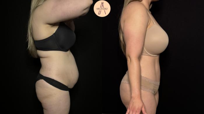 Before & After Tummy Tuck Case 397 Right Side View in San Antonio, Texas