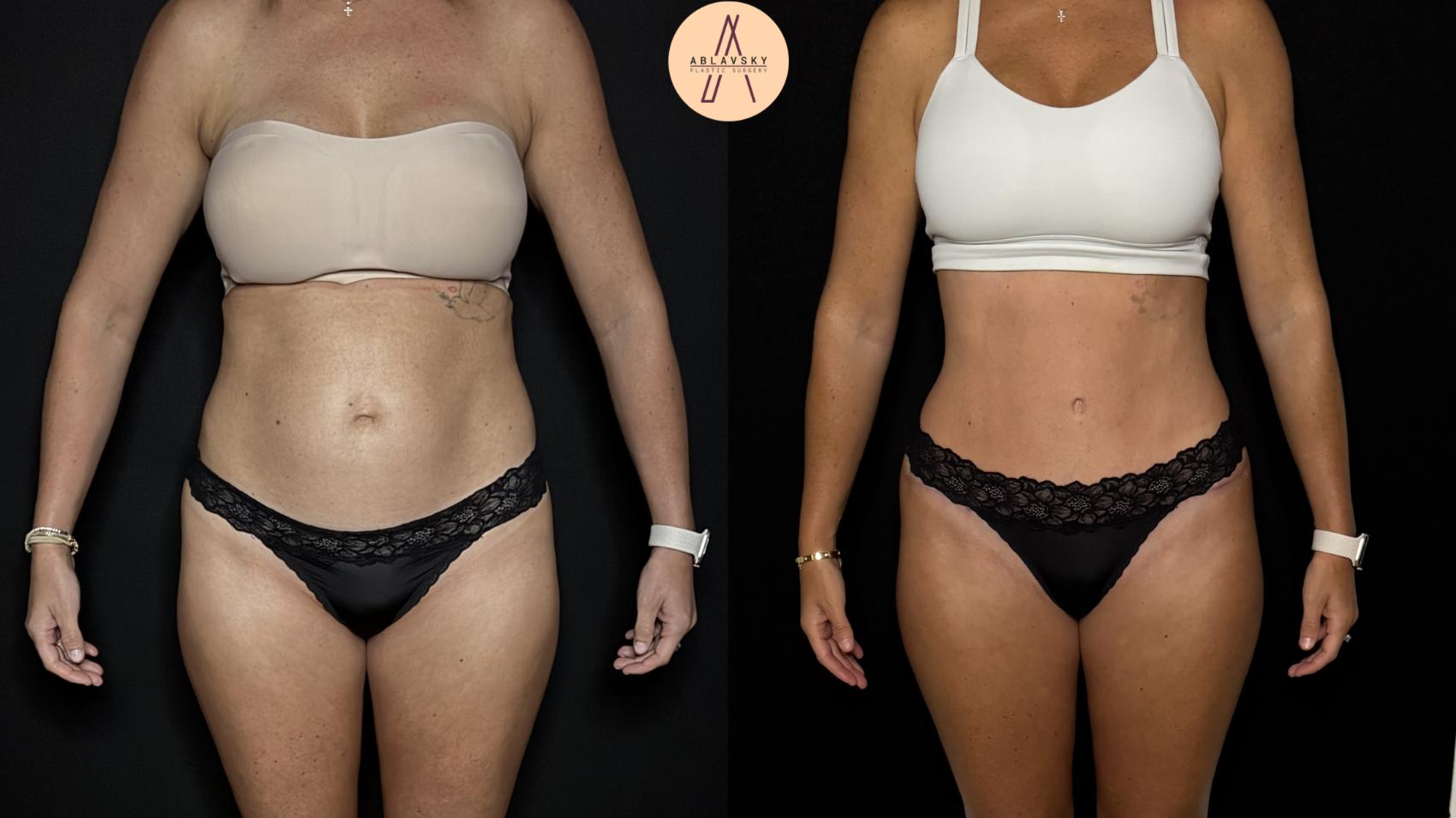 Before & After Tummy Tuck Case 398 Front View in San Antonio, Texas