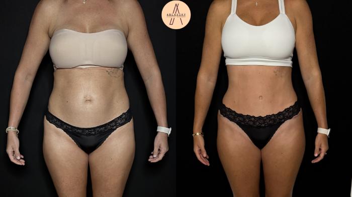 Before & After Tummy Tuck Case 398 Front View in San Antonio, Texas