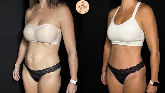 Before & After Tummy Tuck Case 398 Left Oblique View in San Antonio, Texas