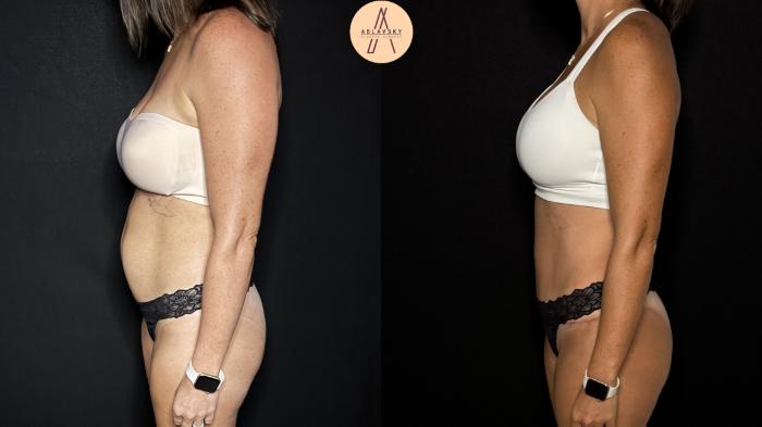 Before & After Tummy Tuck Case 398 Left Side View in San Antonio, Texas