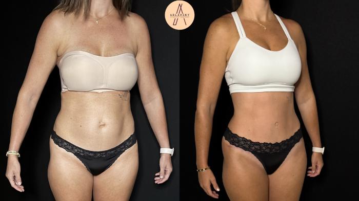 Before & After Tummy Tuck Case 398 Right Oblique View in San Antonio, Texas