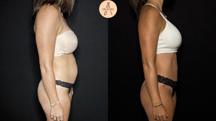 Before & After Tummy Tuck Case 398 Right Side View in San Antonio, Texas