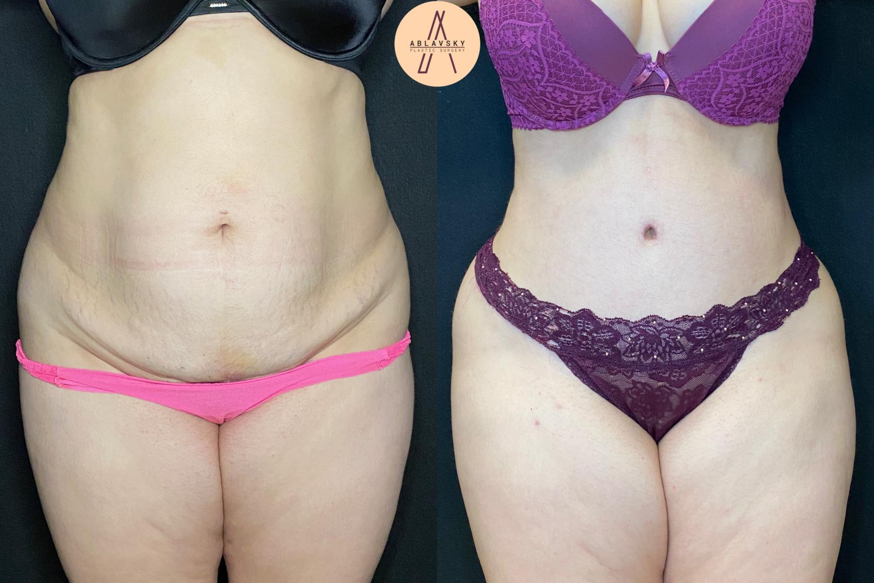 Before & After Tummy Tuck Case 40 Front View in San Antonio, Texas