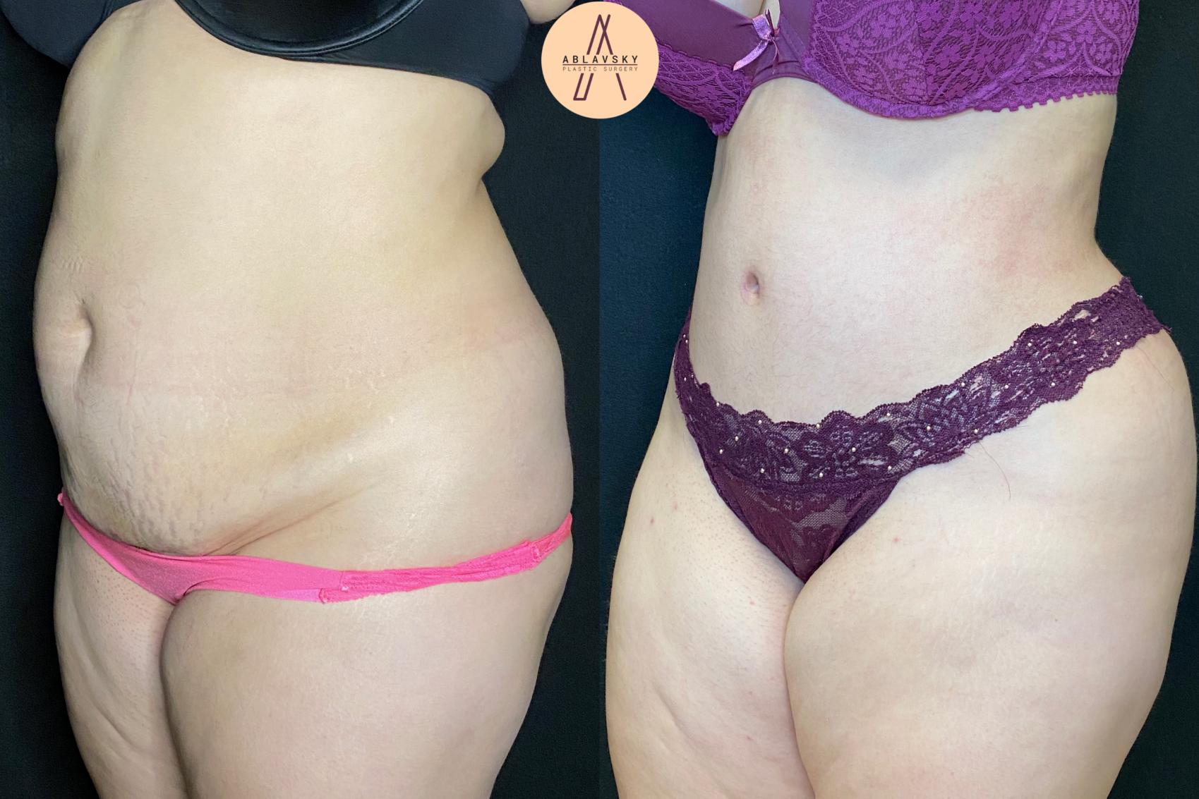 Before & After Tummy Tuck Case 40 Left Oblique View in San Antonio, Texas
