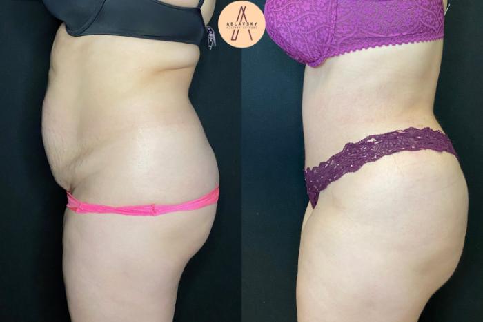 Before & After Tummy Tuck Case 40 Left Side View in San Antonio, Texas