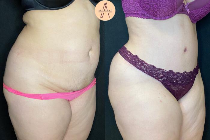 Before & After Tummy Tuck Case 40 Right Oblique View in San Antonio, Texas