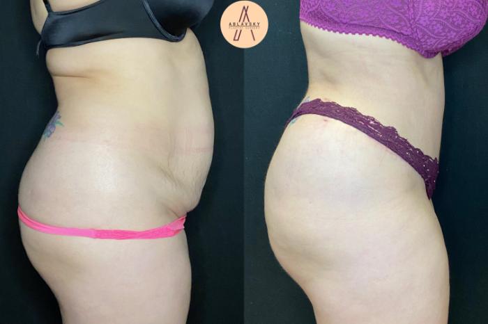 Before & After Tummy Tuck Case 40 Right Side View in San Antonio, Texas