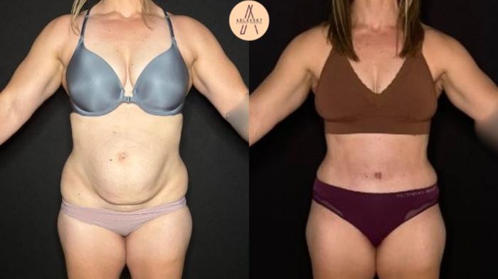 Before & After Tummy Tuck Case 405 Front View in San Antonio, Texas