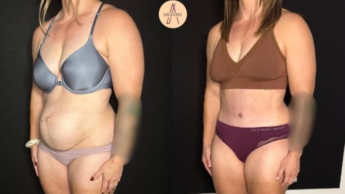 Before & After Tummy Tuck Case 405 Left Oblique View in San Antonio, Texas