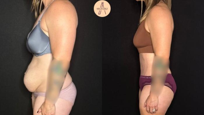 Before & After Tummy Tuck Case 405 Left Side View in San Antonio, Texas