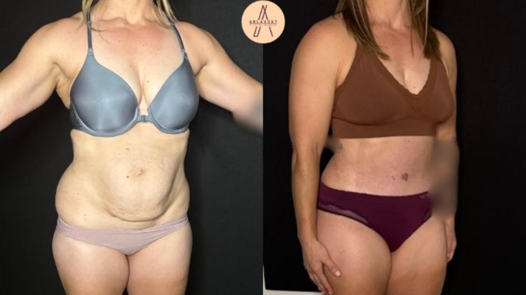 Before & After Tummy Tuck Case 405 Right Oblique View in San Antonio, Texas