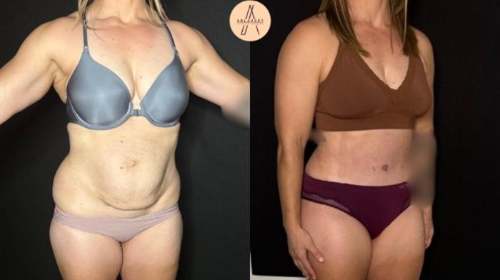 Before & After Tummy Tuck Case 405 Right Oblique View in San Antonio, Texas