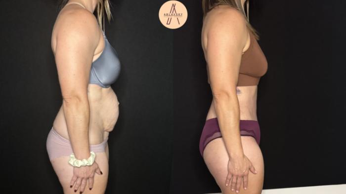 Before & After Tummy Tuck Case 405 Right Side View in San Antonio, Texas