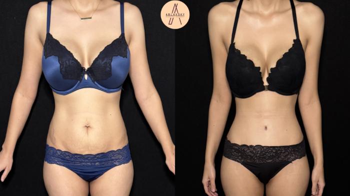 Before & After Tummy Tuck Case 446 Front View in San Antonio, Texas