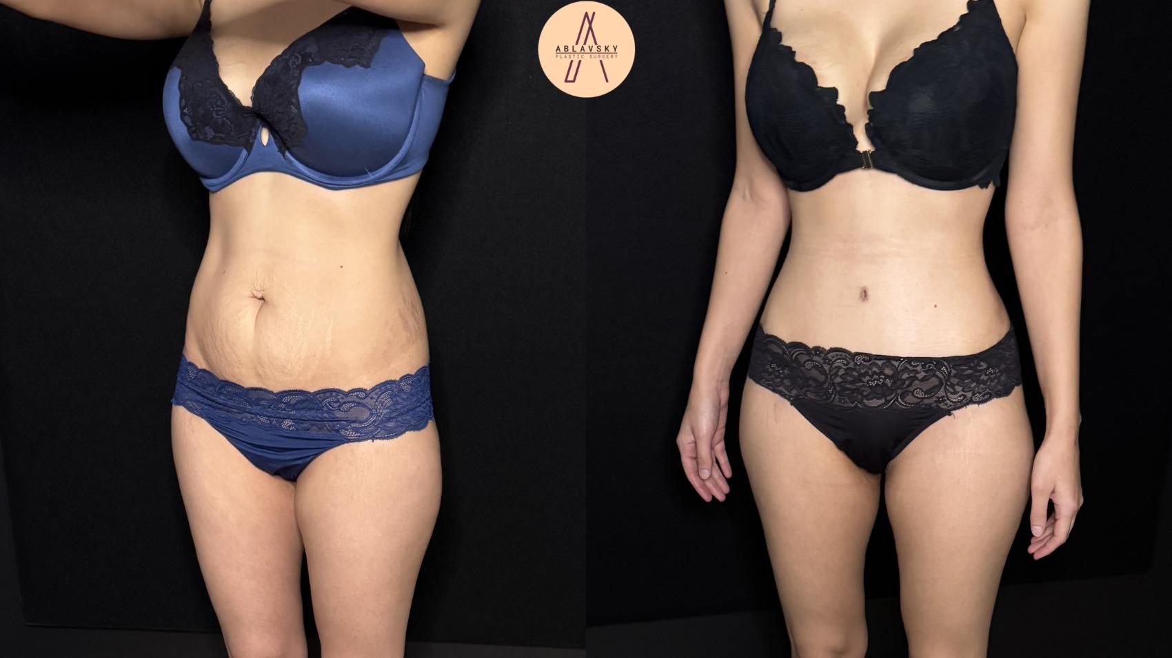 Before & After Tummy Tuck Case 446 Left Oblique View in San Antonio, Texas