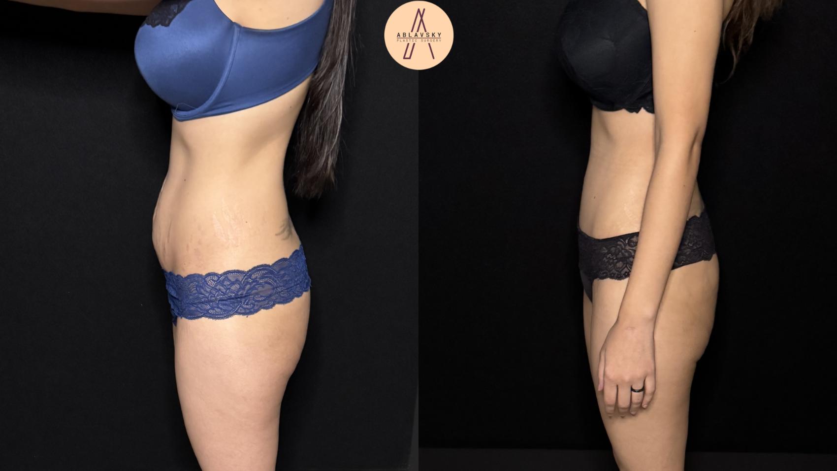 Before & After Tummy Tuck Case 446 Left Side View in San Antonio, Texas