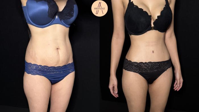 Before & After Tummy Tuck Case 446 Right Oblique View in San Antonio, Texas
