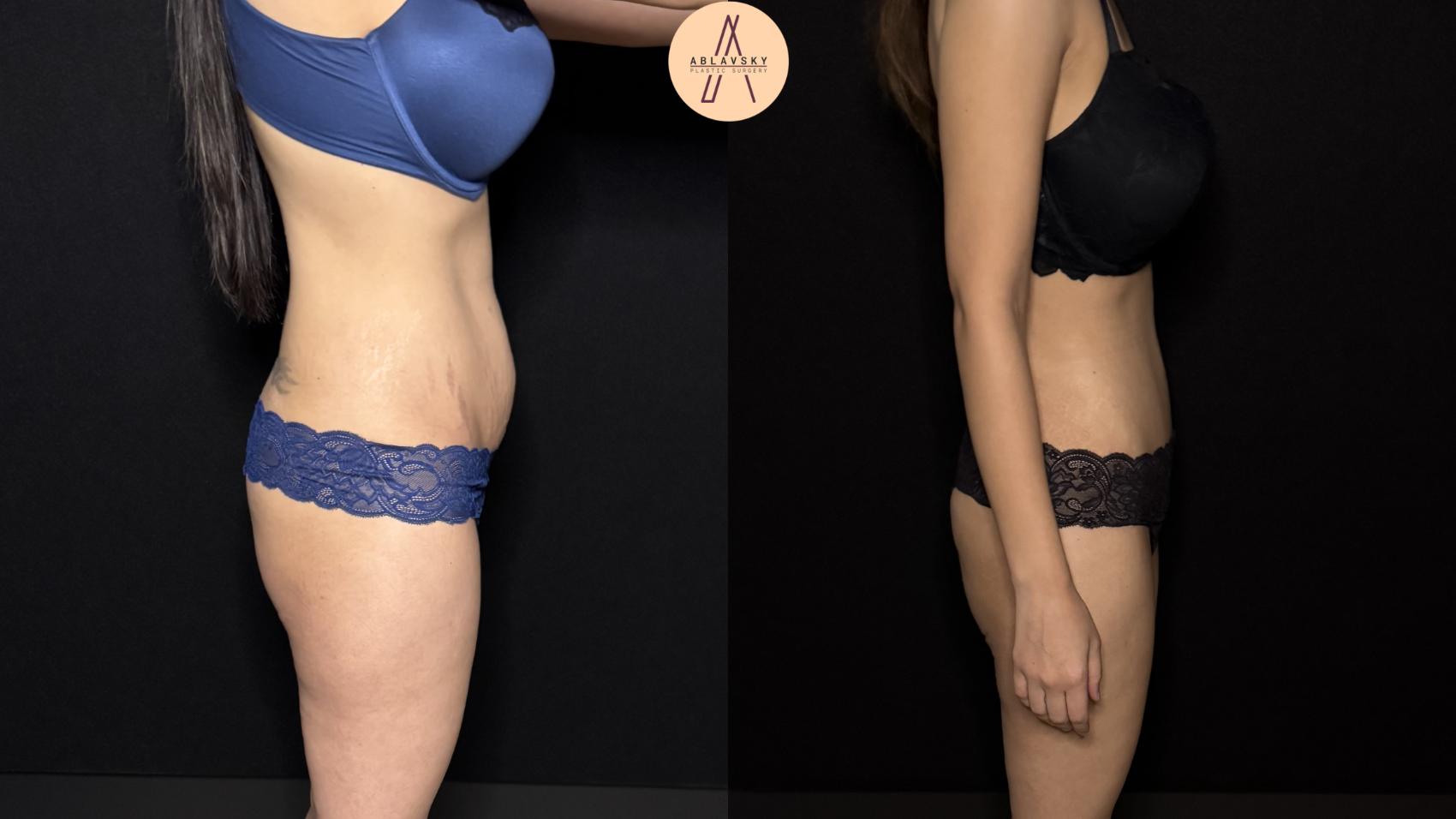 Before & After Tummy Tuck Case 446 Right Side View in San Antonio, Texas