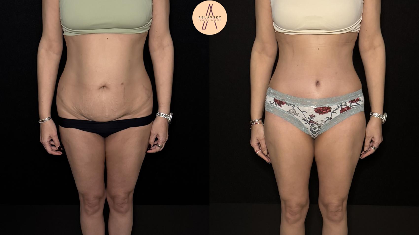 Before & After Tummy Tuck Case 475 Front View in San Antonio, Texas