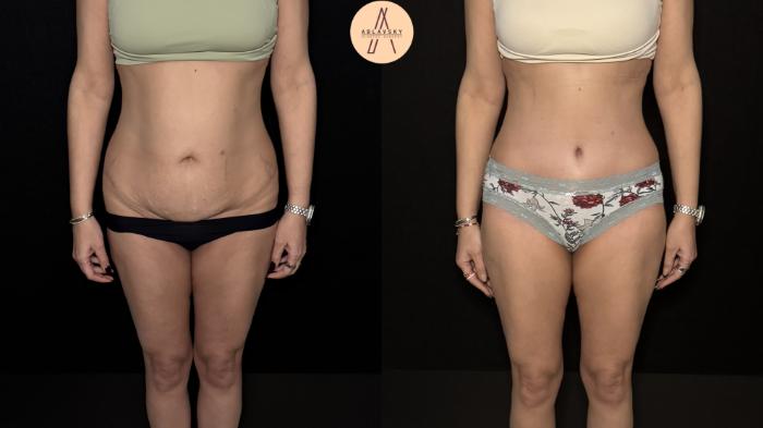 Before & After Tummy Tuck Case 475 Front View in San Antonio, Texas