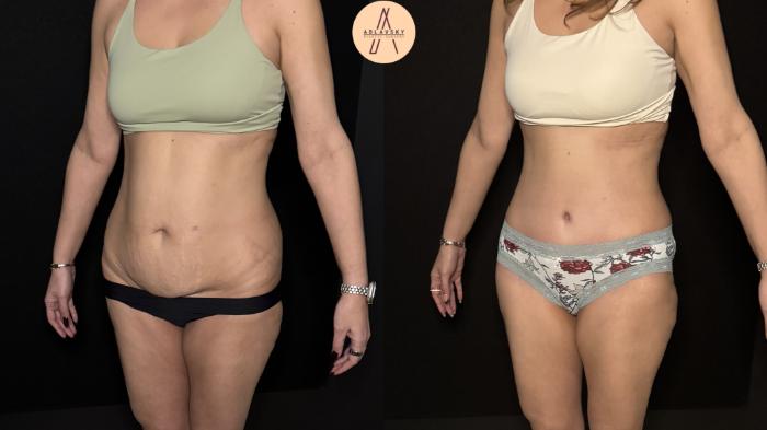 Before & After Tummy Tuck Case 475 Left Oblique View in San Antonio, Texas