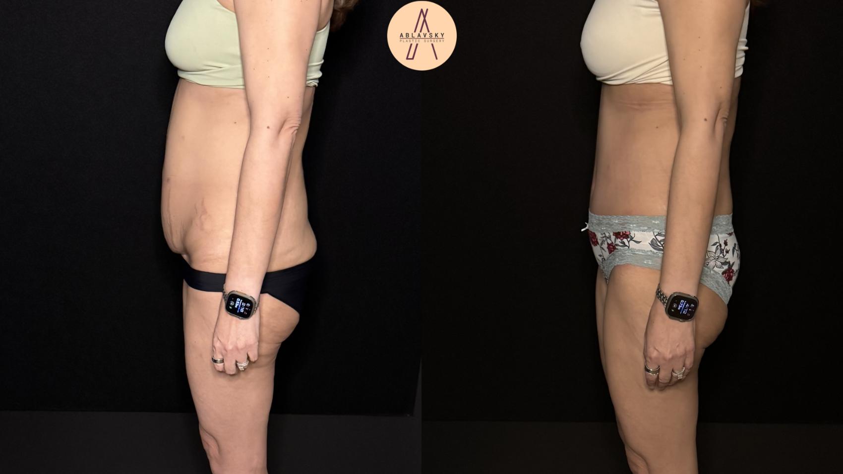 Before & After Tummy Tuck Case 475 Left Side View in San Antonio, Texas