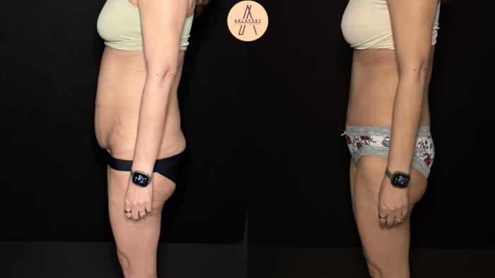 Before & After Tummy Tuck Case 475 Left Side View in San Antonio, Texas