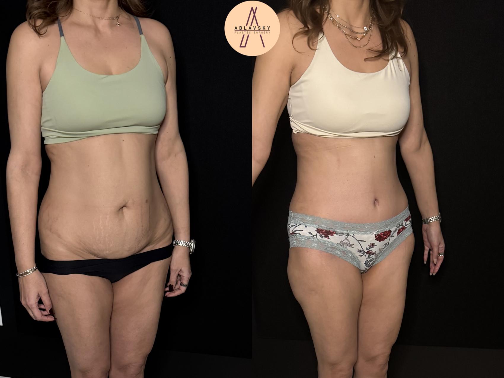 Before & After Tummy Tuck Case 475 Right Oblique View in San Antonio, Texas