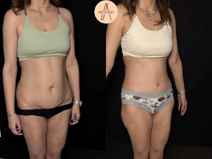 Before & After Tummy Tuck Case 475 Right Oblique View in San Antonio, Texas