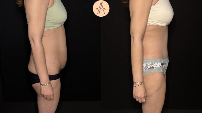 Before & After Tummy Tuck Case 475 Right Side View in San Antonio, Texas