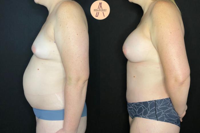 Before & After Tummy Tuck Case 53 Left Side View in San Antonio, Texas