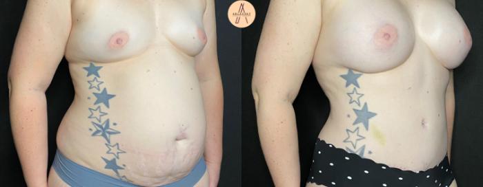 Before & After Tummy Tuck Case 53 Right Oblique View in San Antonio, Texas