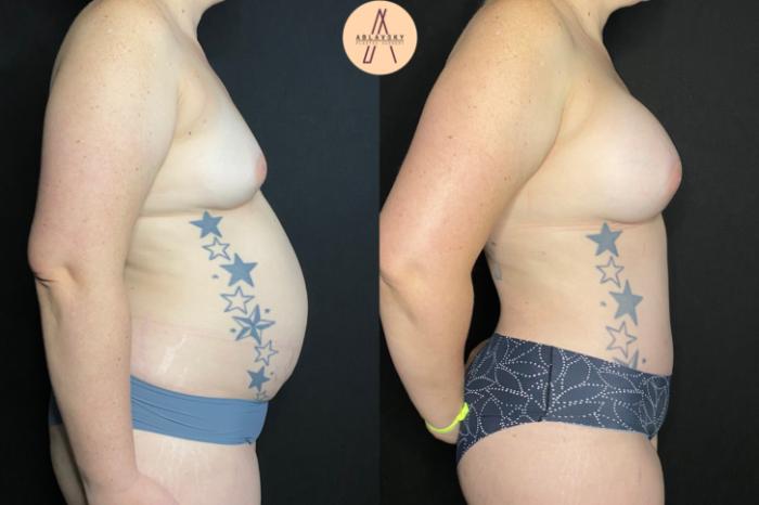 Before & After Tummy Tuck Case 53 Right Side View in San Antonio, Texas