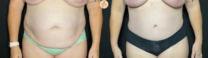 Before & After Tummy Tuck Case 60 Front View in San Antonio, Texas
