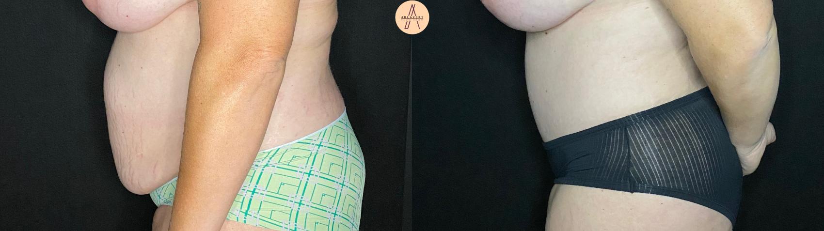Before & After Liposuction Case 60 Left Side View in San Antonio, Texas