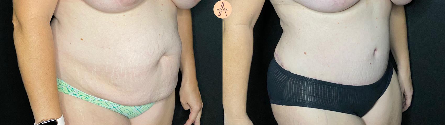 Before & After Liposuction Case 60 Right Oblique View in San Antonio, Texas