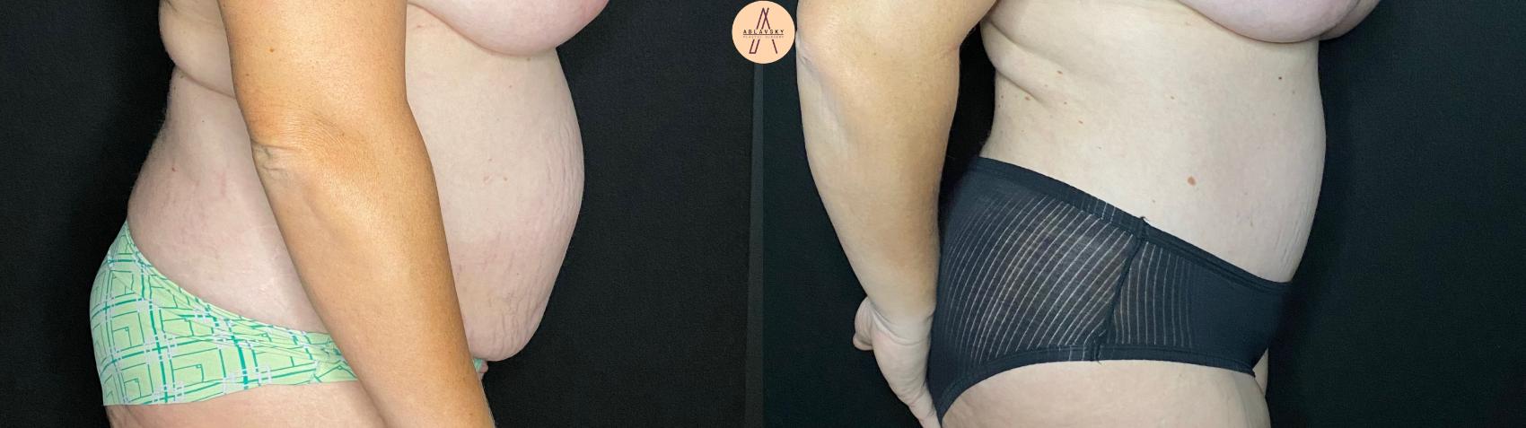 Before & After Liposuction Case 60 Right Side View in San Antonio, Texas