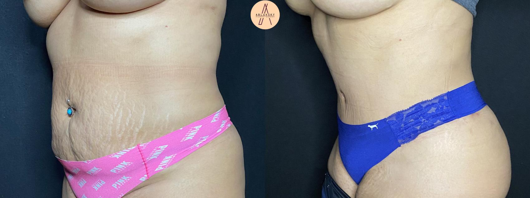 Before & After Tummy Tuck Case 62 Left Oblique View in San Antonio, Texas