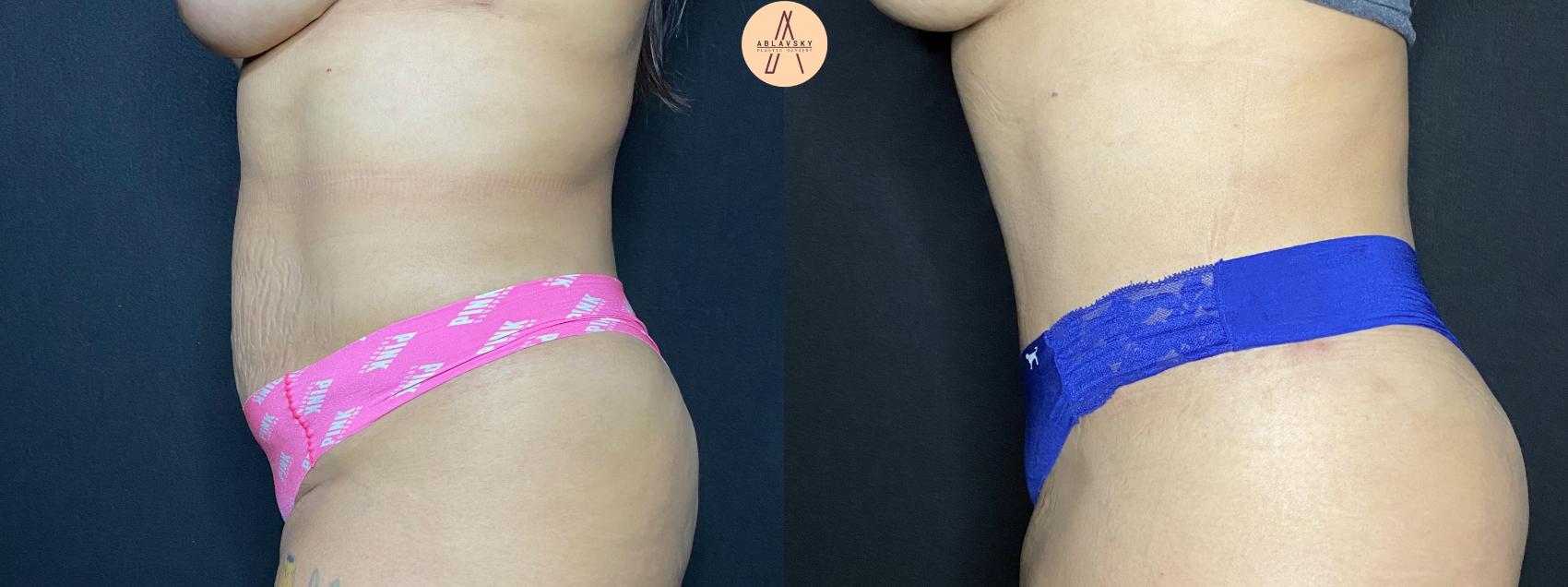Before & After Tummy Tuck Case 62 Left Side View in San Antonio, Texas