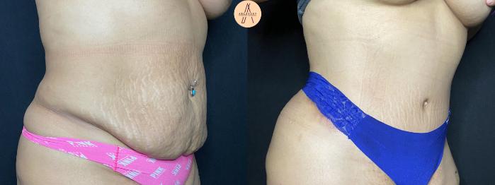 Before & After Tummy Tuck Case 62 Right Oblique View in San Antonio, Texas