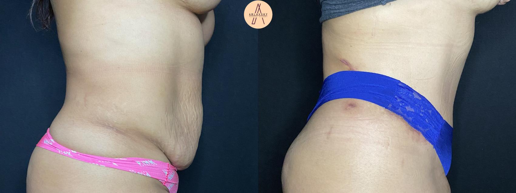 Before & After Tummy Tuck Case 62 Right Side View in San Antonio, Texas